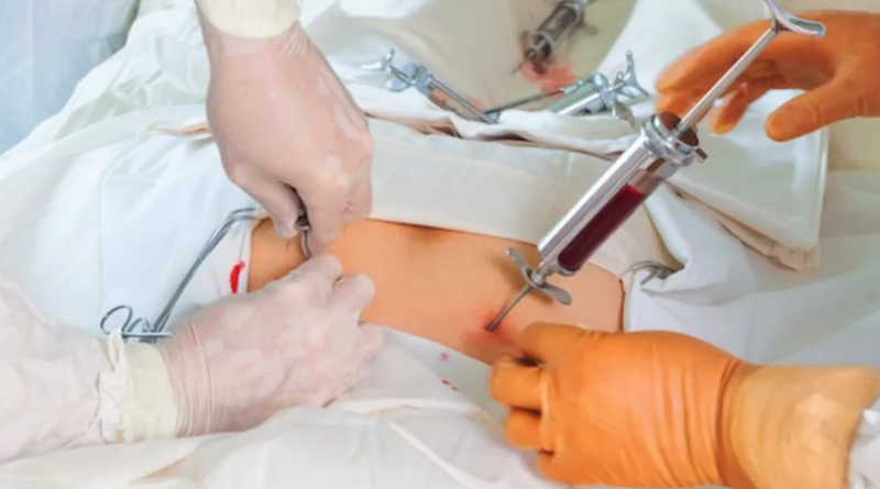 Exploring the World of Stem Cell Transplants